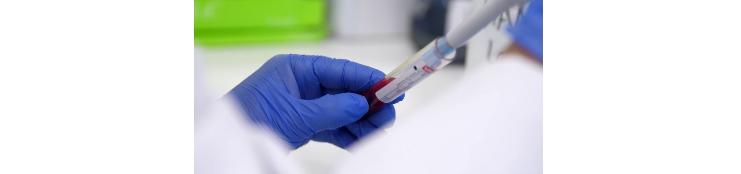 El Instituto i+12 participa en una investigación que utiliza la IA para predecir la respuesta a inmunoterapia en cáncer de pulmón